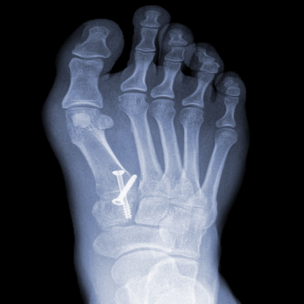 Bunion X-ray after surgical correction