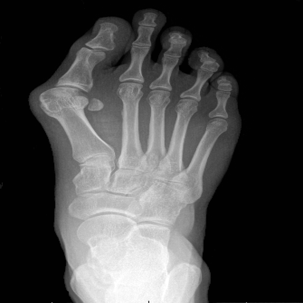 Bunion X-ray before surgical correction